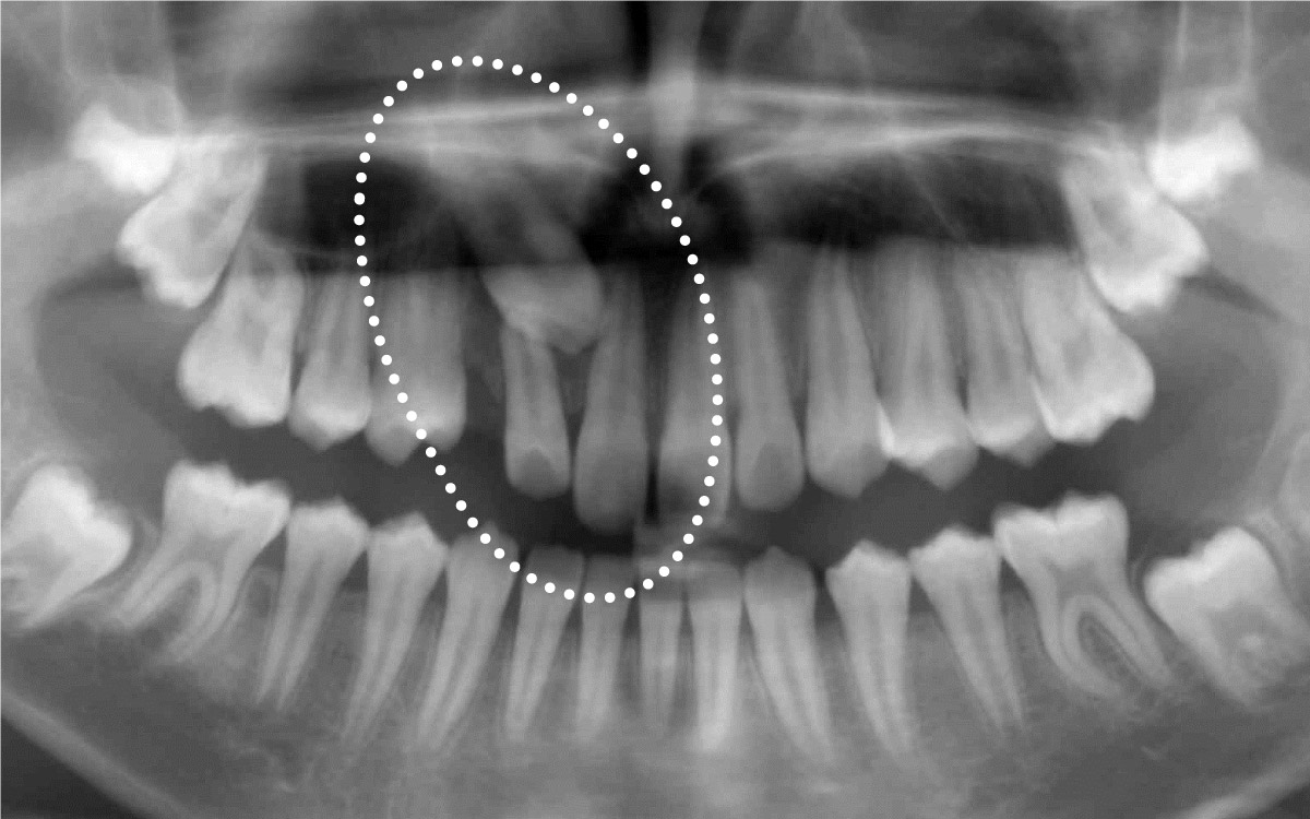 画像：永久歯の埋伏・位置異常（歯が埋まって生えてこない）・萌出遅延