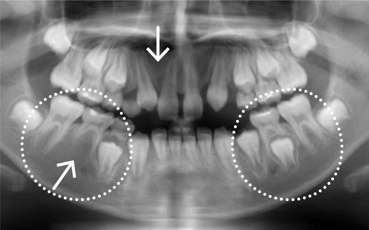 画像：永久歯の先天性欠損（生まれつき永久歯の数が足りない）