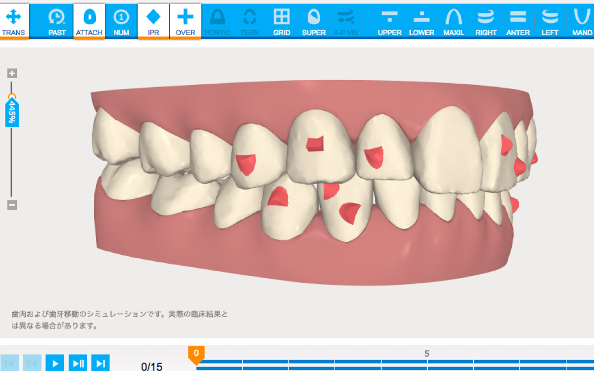 画像：歯並びをシミュレーション