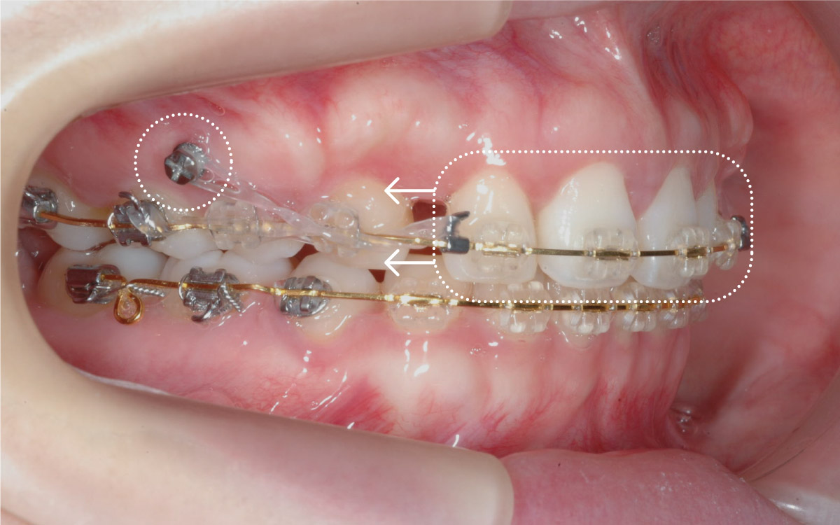 歯科矯正用アンカースクリューを併用した矯正治療 | 原宿外苑矯正歯科 