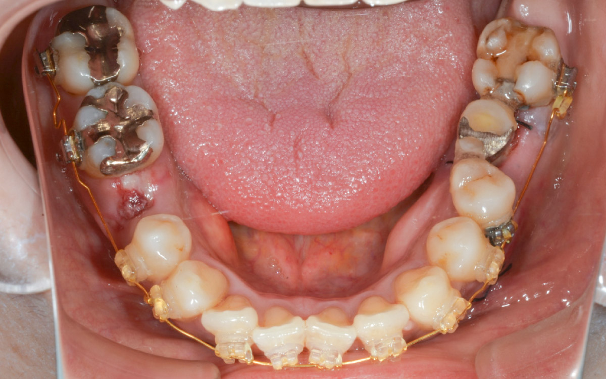 画像：歯の移植術（30〜60分程度）
