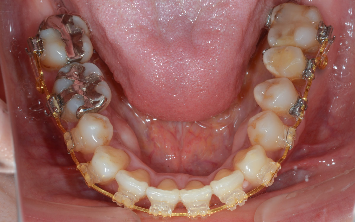 画像：移植歯の矯正治療